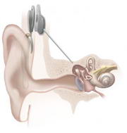 Hearing-Loss